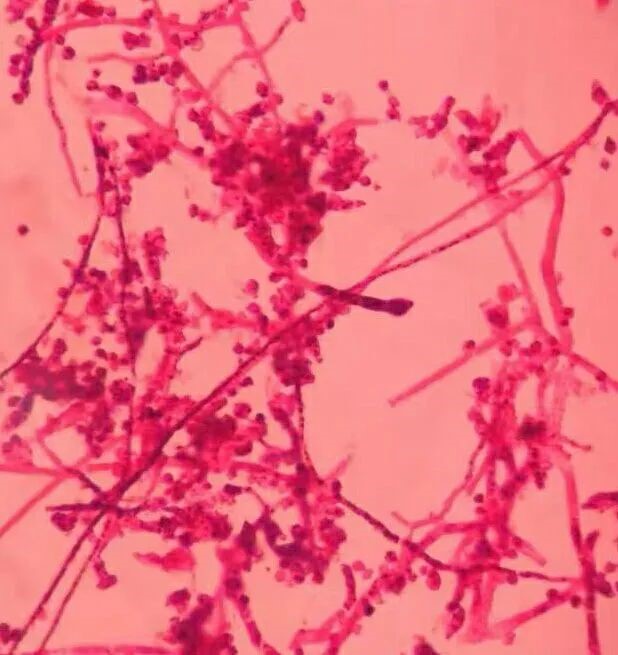 沙氏平板室温20℃培养第11天，革兰染色